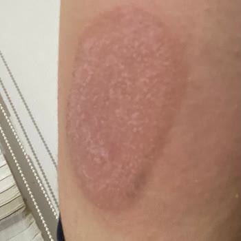 Dexcom G6 Alerji Şikayeti