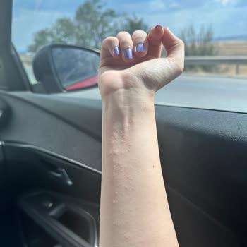 Mustela Çatlak Kremi Alerjisi