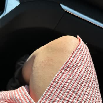 Mustela Çatlak Kremi Alerjisi