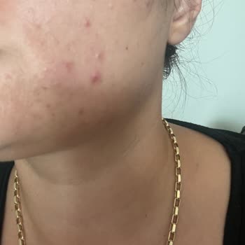 Naturagen Kolajen Gurme Sivilce Yaptı