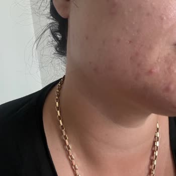 Naturagen Kolajen Gurme Sivilce Yaptı