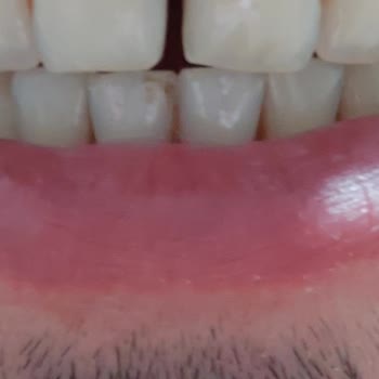 Avrupadent Buca Şirinyer Şubesinde Yaşanan Diş Tedavisi Sorunu