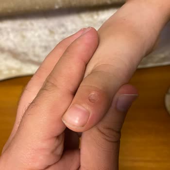 FLO Ayakkabı Çocuk Ayakkabısının Ayakta Yaptığı Yara