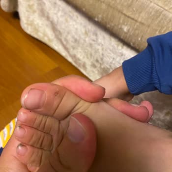 FLO Ayakkabı Çocuk Ayakkabısının Ayakta Yaptığı Yara