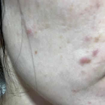 The Purest Solutions The Purest Sivilce Karşıtı Sarı Tonik