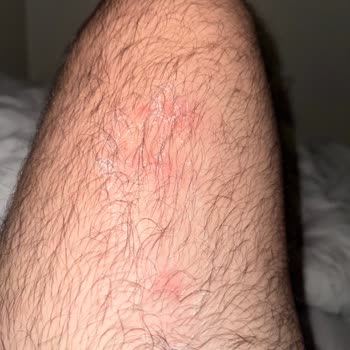 Anadol Hotel Girne Otel Odasında Tahtakurusu Sorunu Ve İade Problemi