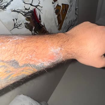 Anadol Hotel Girne Otel Odasında Tahtakurusu Sorunu Ve İade Problemi