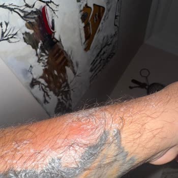 Anadol Hotel Girne Otel Odasında Tahtakurusu Sorunu Ve İade Problemi