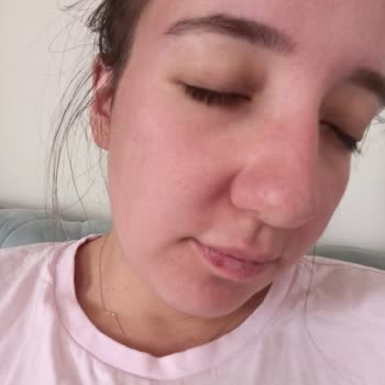 Nivea Yüz Tahrişi Ve Yüz Yanması