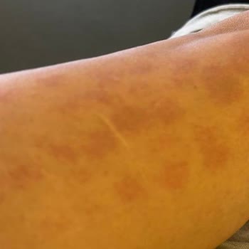 Esteworld Lazerde Kolumu Yaktılar