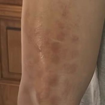 Esteworld Lazerde Kolumu Yaktılar