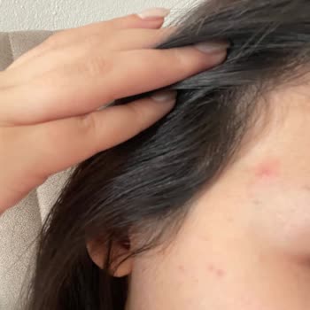 Yves Rocher Yüz Temizleme Jeli Sivilce Problemi