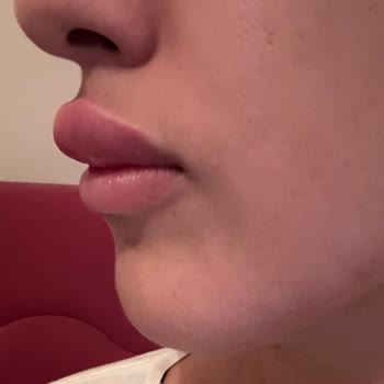 Luvimed Clinic Luvimed Caddede Yapılan Dolgunun Şişmesi