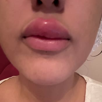 Luvimed Clinic Luvimed Caddede Yapılan Dolgunun Şişmesi