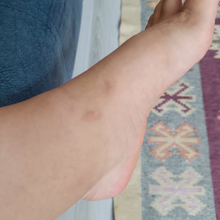 Skechers Sandalet Ayakta Morarma Yapıyor