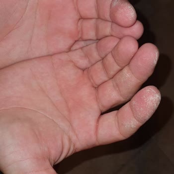 Vanish Kosla Cildimi Tahriş Etti