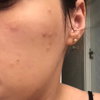 Mrs. Umrantoo Mrs. Ümranto Krem Sivilce Çıkardı