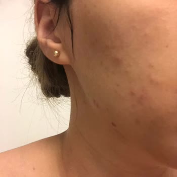 Mrs. Umrantoo Mrs. Ümranto Krem Sivilce Çıkardı