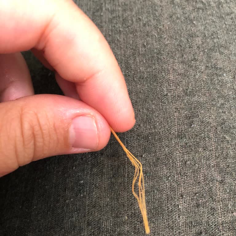 Ruffles İçinden Çıkan Yabancı Cisim