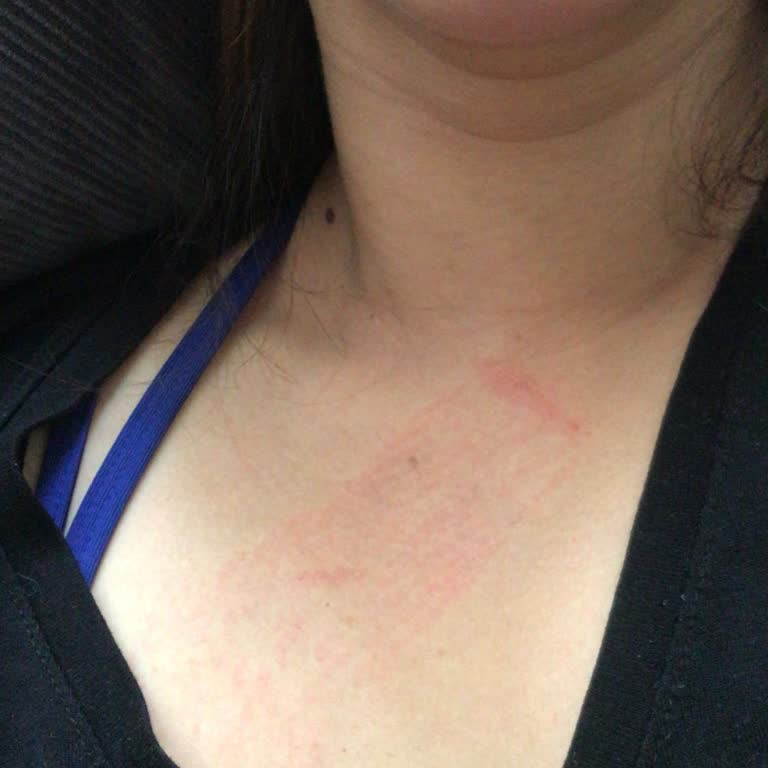 Getwell Göğüs Bandı Yara Yapıyor