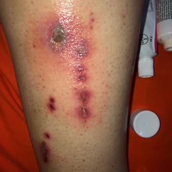 Philips Lumea Prestige BRi950 quemó mi pierna