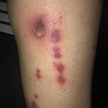 Philips Lumea Prestige BRi950 quemó mi pierna