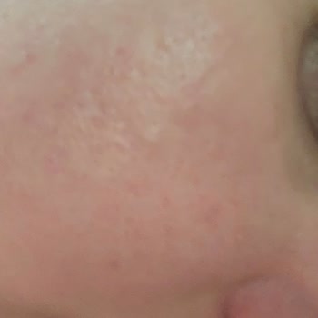 Yves Rocher İle Yüzüm Yandı