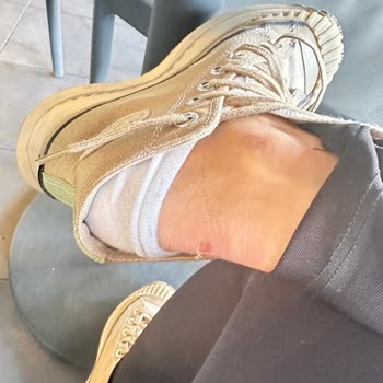 Converse Zapatos Ampollas Dolorosas, Reembolso Negado