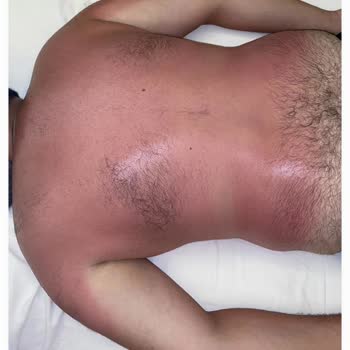 Sebamed SPF 50 Protector Solar Causó Quemaduras Solares