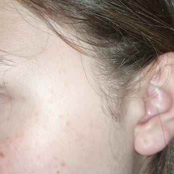 Limpiador Facial Loreal Paris Me Causó Dolorosos Granos