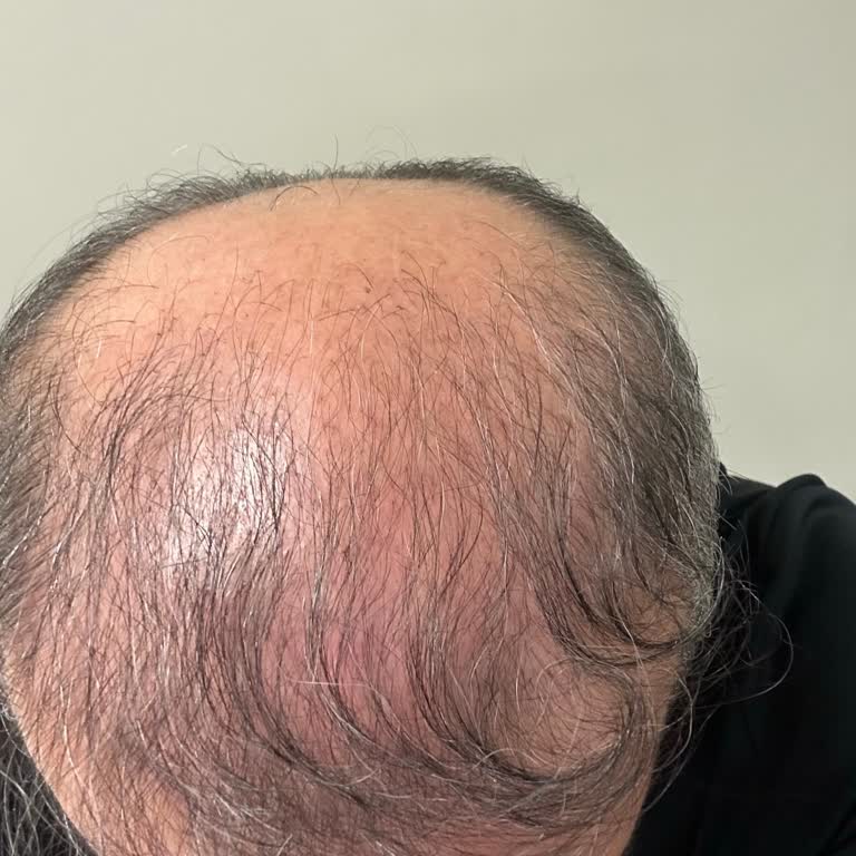 Arşimed Saç Ekimi Tam Bir Hayal Kırıklığı