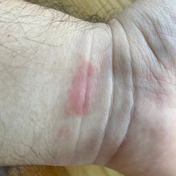 Irritación con Apple Watch 7 Nike 41 Banda