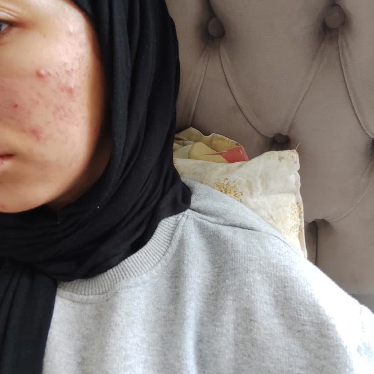 Loreal Paris Bright Reveal Yenileyici Peeling Sonrası Sivilcelenme