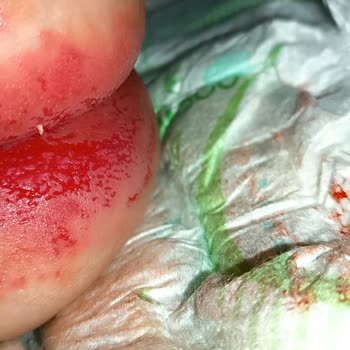 Molfix Mantar Ve Pişik