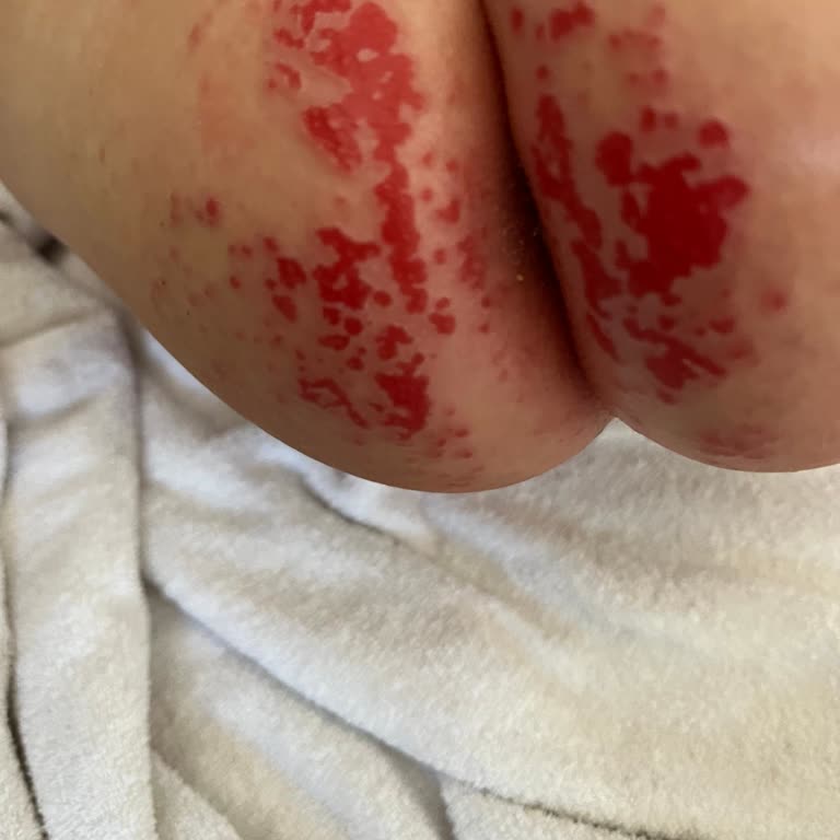 Molfix Mantar Ve Pişik