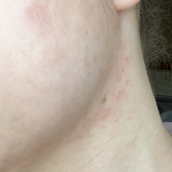 Yves Rocher Temizleme Jeli Alerji
