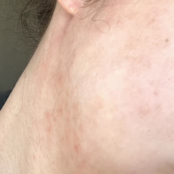 Yves Rocher Temizleme Jeli Alerji