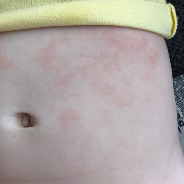 Mustela Pişik Önleyici Bebeğimde Alerji Yaptı