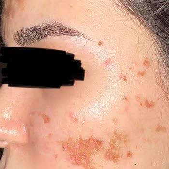 Mira Güzellik Merkezi (Denizli) Yüzümü İşlemde Yaktılar!