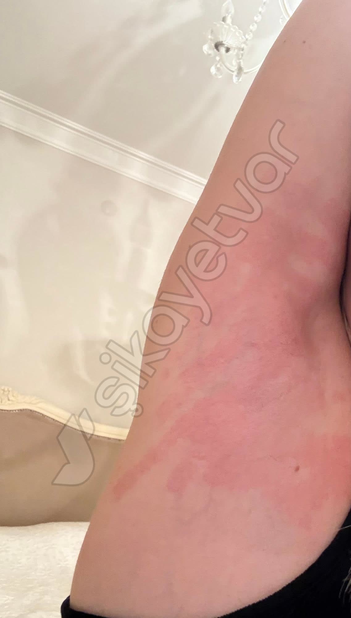 Lazer ve Lazer Epilasyon Şikayetleri - 85200 - Şikayetvar