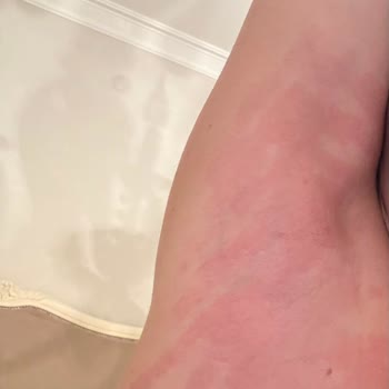 Dekolte Plus Güzellik Merkezi Buz Lazer Epilasyonunda Yaşadığım Acı Ve Yanık Problemi