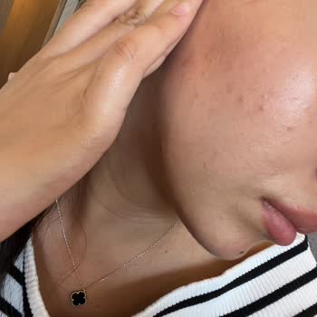 Rossmann Cilt Sorunları Yaşatan Jel