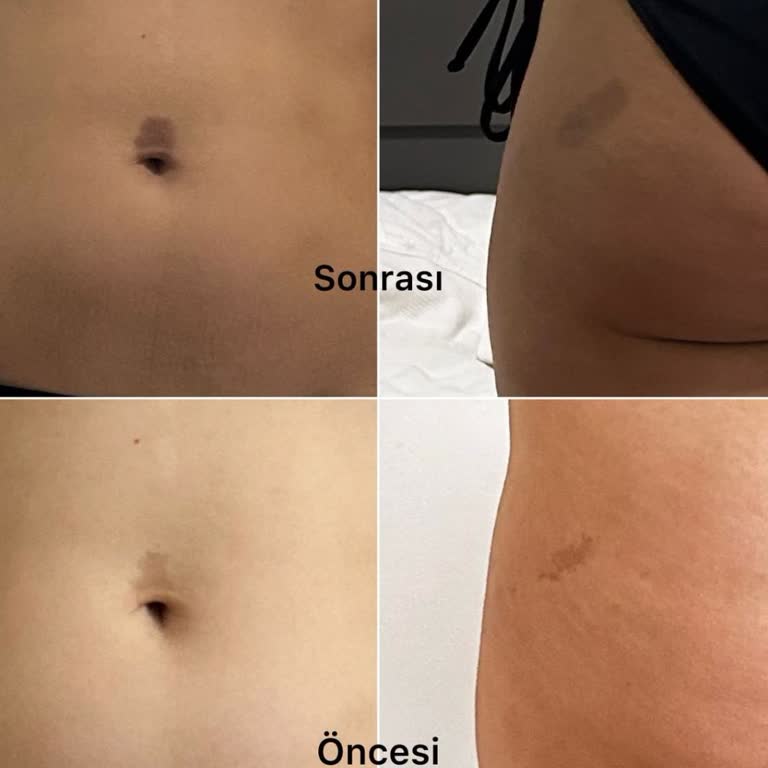 UniQue Epilasyon ve Güzellik Leke Silme Prosedürü Fiyaskosu Ve Profesyonellik Sorunu