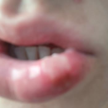 Baydent Diş Sağlığı Polikliniği Pendik Baydent Dudağımı Yaktılar