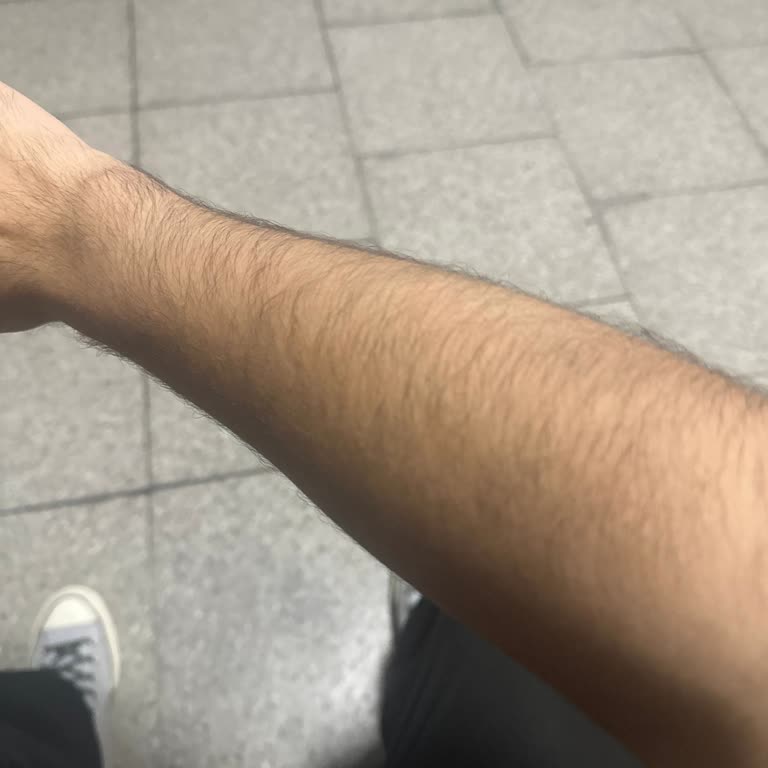 Dermasam Lazer Epilasyon Merkezleri Lazer Epilasyon İşe Yaramadı