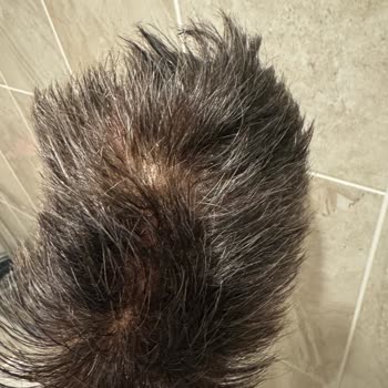 Hairplus Kadıköy Protez Saç Merkezi'nde Büyük Hayal Kırıklığı