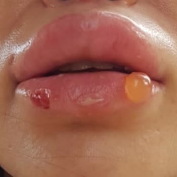 Dr. Hüseyin Tırman Polikliniği Lazer Tedavisi Sonrası Dudaklarımda Kalıcı Hasar Oluştu