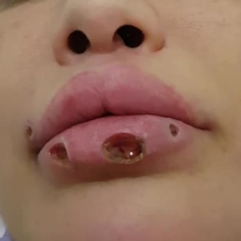Dr. Hüseyin Tırman Polikliniği Lazer Tedavisi Sonrası Dudaklarımda Kalıcı Hasar Oluştu