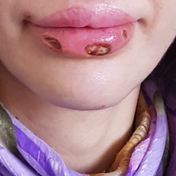 Dr. Hüseyin Tırman Polikliniği Lazer Tedavisi Sonrası Dudaklarımda Kalıcı Hasar Oluştu