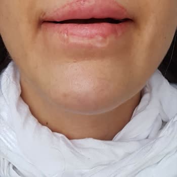 Dr. Hüseyin Tırman Polikliniği Lazer Tedavisi Sonrası Dudaklarımda Kalıcı Hasar Oluştu